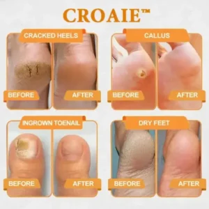 CROAIE™ Bee Venom & Herbal Slimming Foot Patches for Lymphatic Support and Blood Sugar Balance – Natural Swelling Reduction & Detox