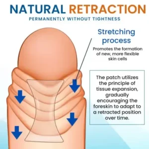 AEXZR™ Prepuce Correction Patch